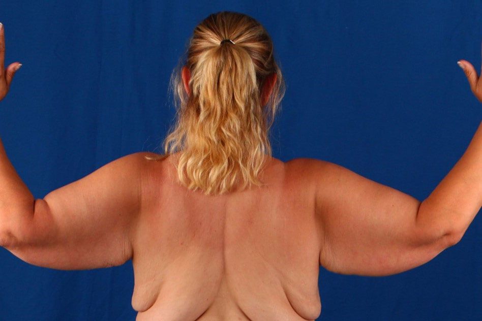 Arm Lift — before