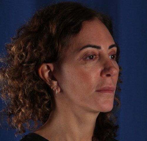 After — facelift and neck lift result, oblique view