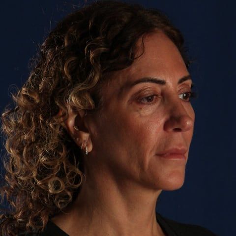 Facelift & Neck Lift — before