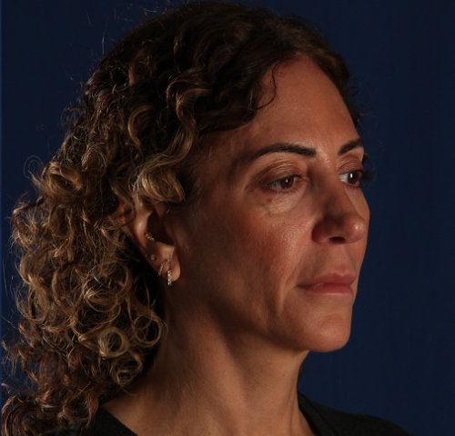 Before — facelift and neck lift result, oblique view