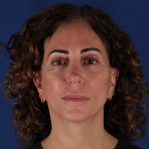 After — facelift and neck lift result, profile view