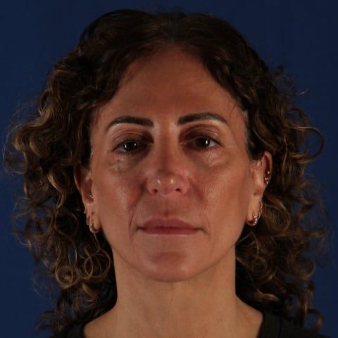 Before — facelift and neck lift result, profile view