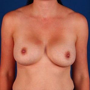 Before — Breast augmentation before and after — implant result