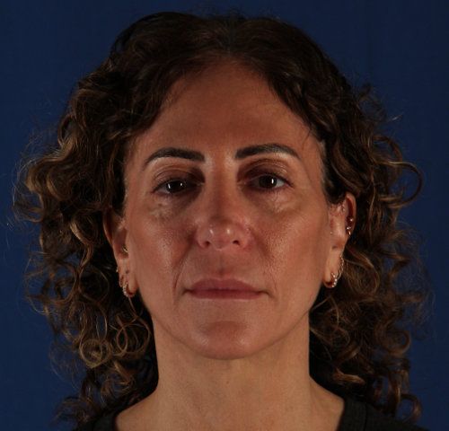 Before — facelift and neck lift result, profile view