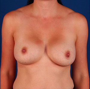 Before — Breast augmentation before and after — implant result
