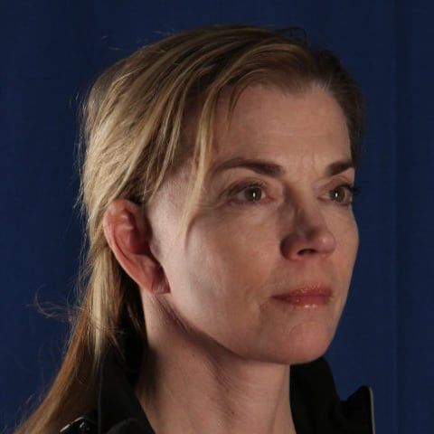 After — facelift and neck lift result, front view