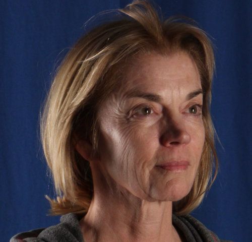 Before — facelift and neck lift result, front view