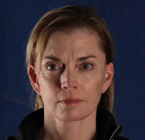 After — facelift and neck lift result, three-quarter view