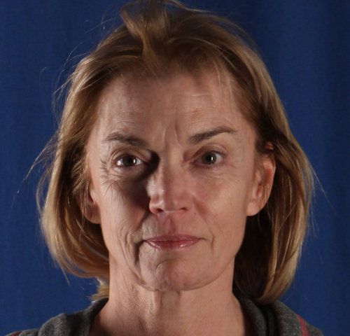 Before — facelift and neck lift result, three-quarter view