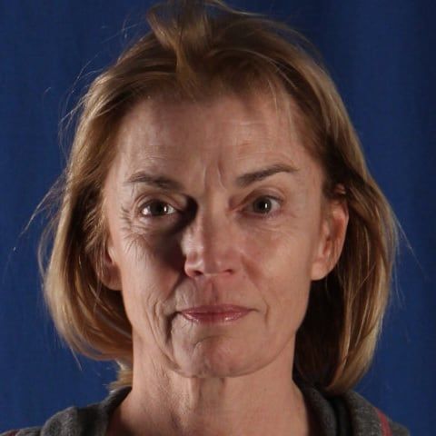 Before — facelift and neck lift result, three-quarter view