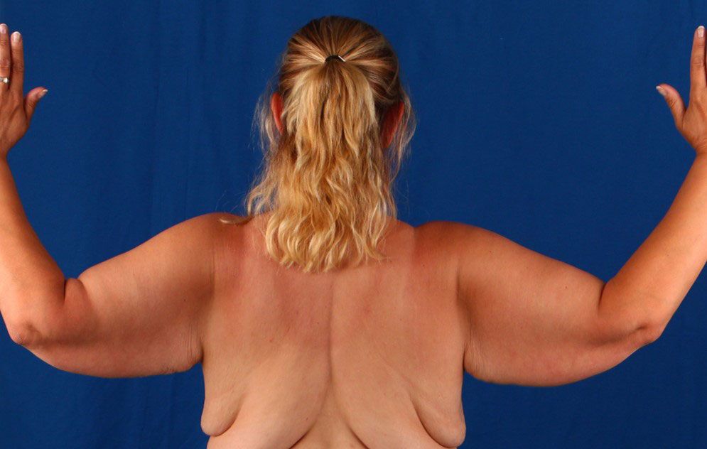 Brachioplasty — before