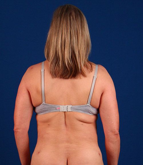 After — BodyTite before and after — abdomen and waist contouring