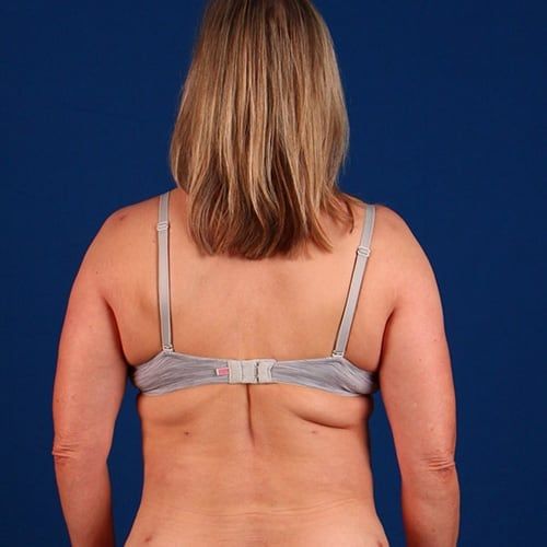 After — BodyTite before and after — abdomen and waist contouring