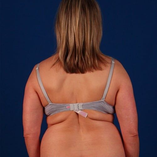 Before — BodyTite before and after — abdomen and waist contouring