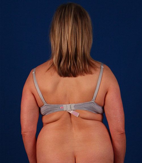 Before — BodyTite before and after — abdomen and waist contouring