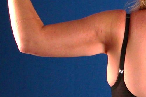 After — BodyTite before and after — arm skin tightening