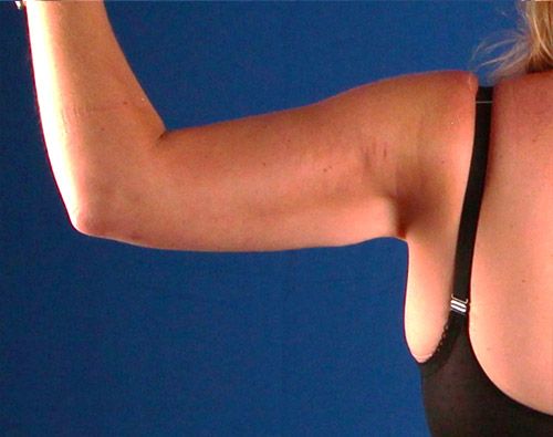 After — BodyTite before and after — arm skin tightening