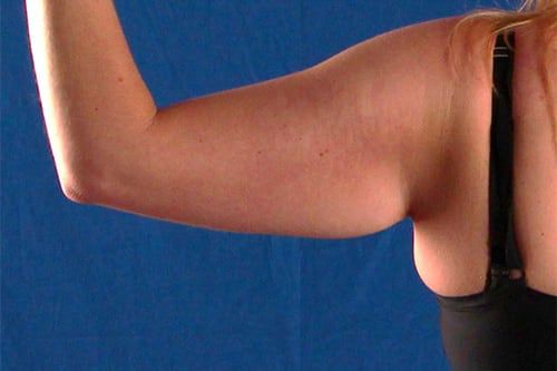 Before — BodyTite before and after — arm skin tightening