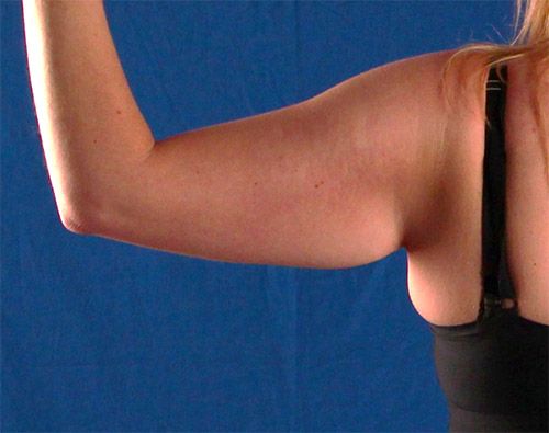 Before — BodyTite before and after — arm skin tightening