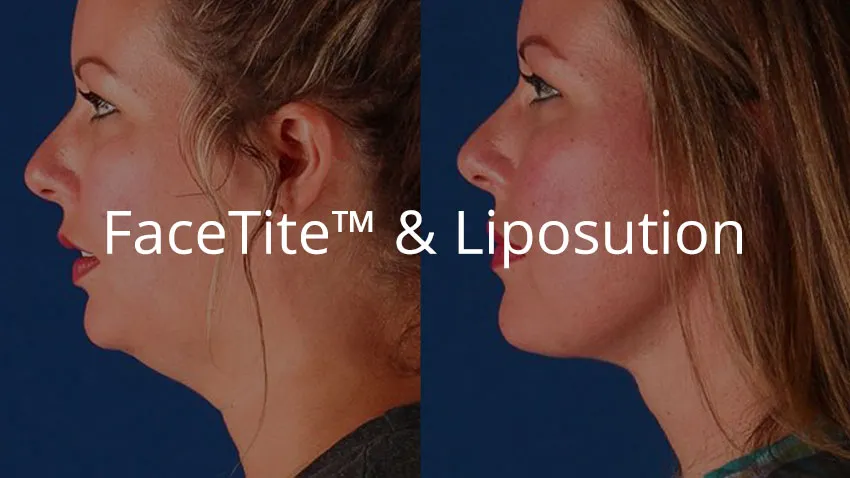 FaceTite and Liposuction