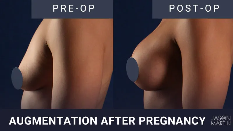 Breast Augmentation: After Pregnancy
