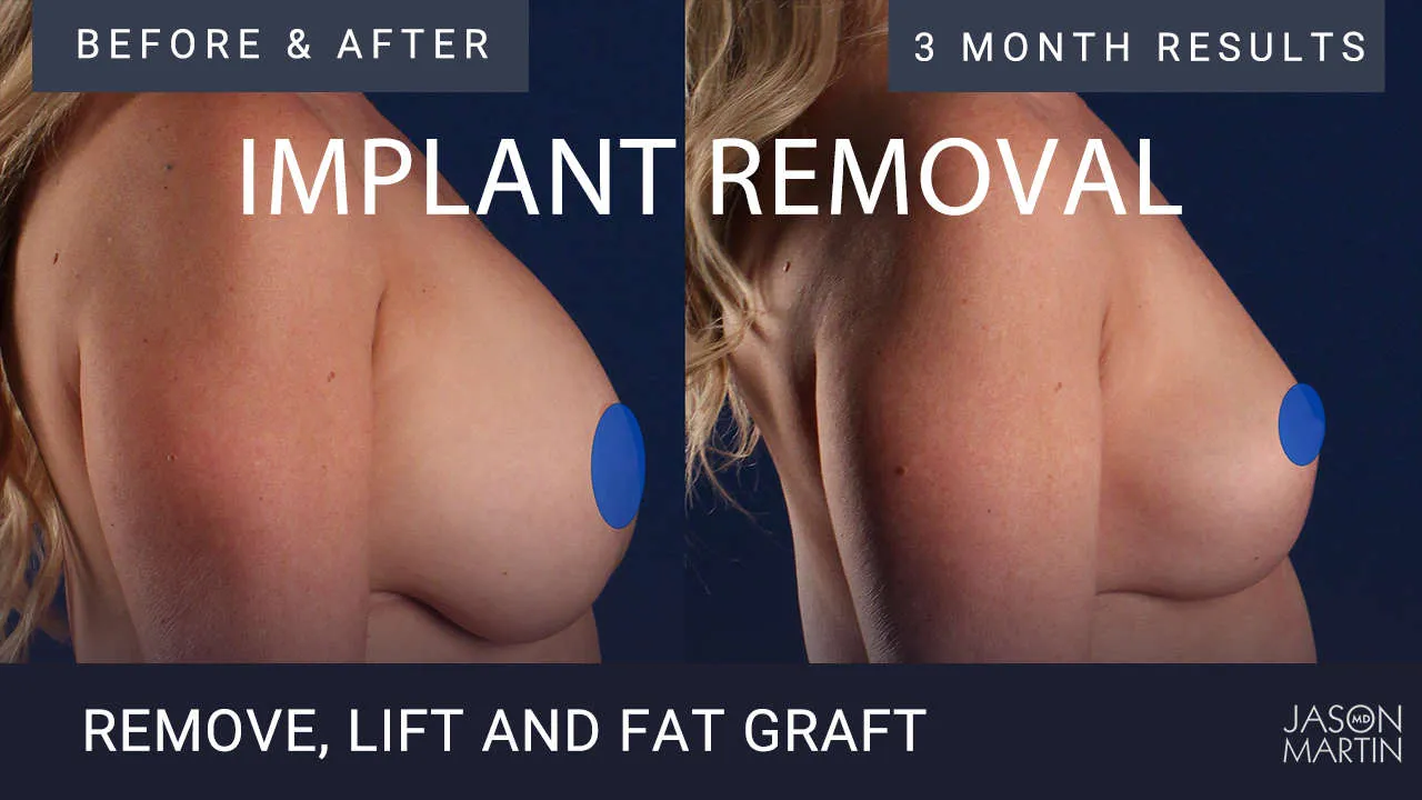 Fat Grafting, the alternative to Breast Implants