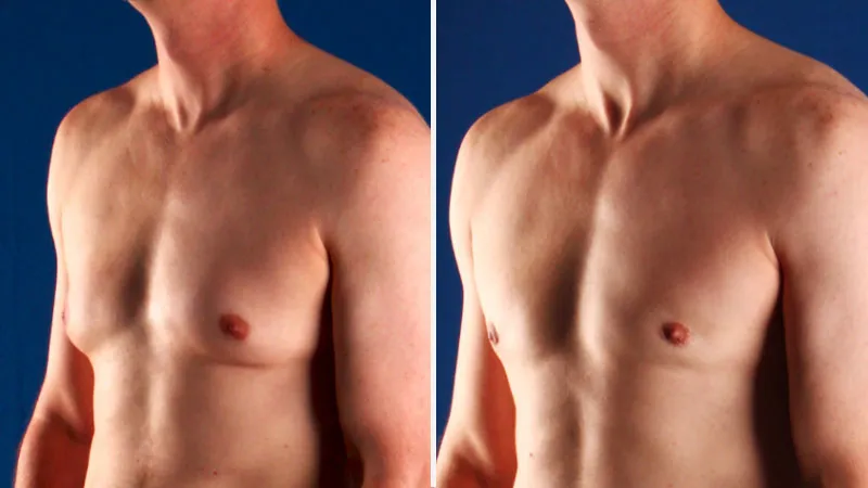 gynecomastia in denver