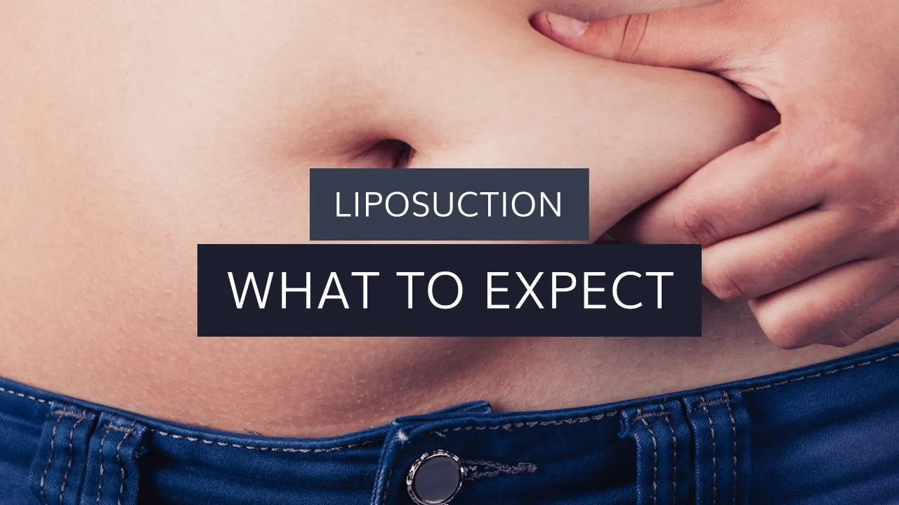 Liposuction: What to Expect