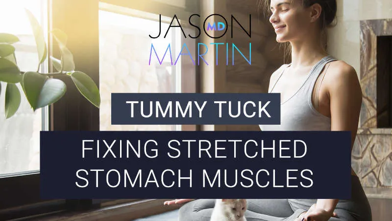 Fixing Stretched Stomach Muscles with a Tummy Tuck