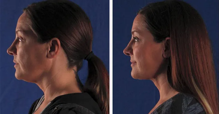 Can FaceTite™ Make My Neck Right?