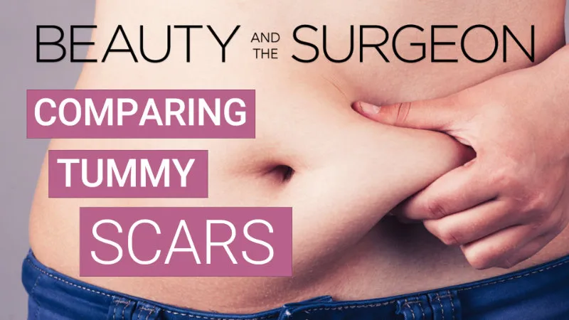 Comparing different types of Tummy Tuck Scars