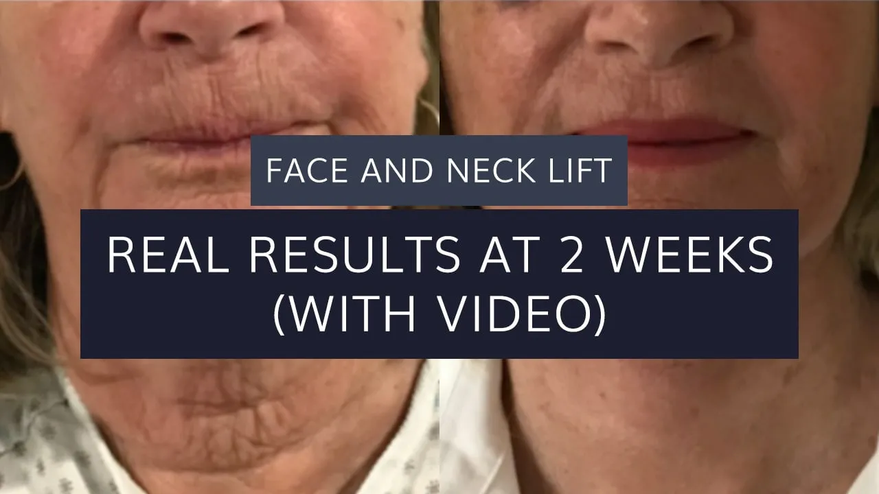 Face and Neck Lift: Real Results at 2 Weeks (with video)