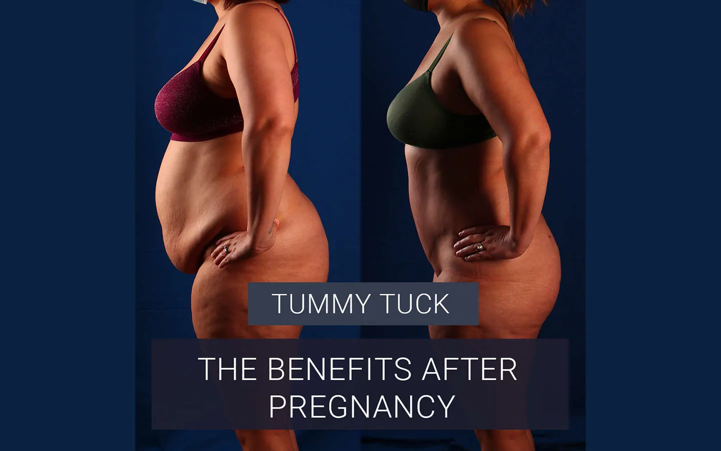 Tummy Tuck: The Benefits After Pregnancy