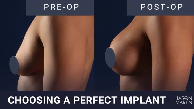 Choosing a Perfect Implant