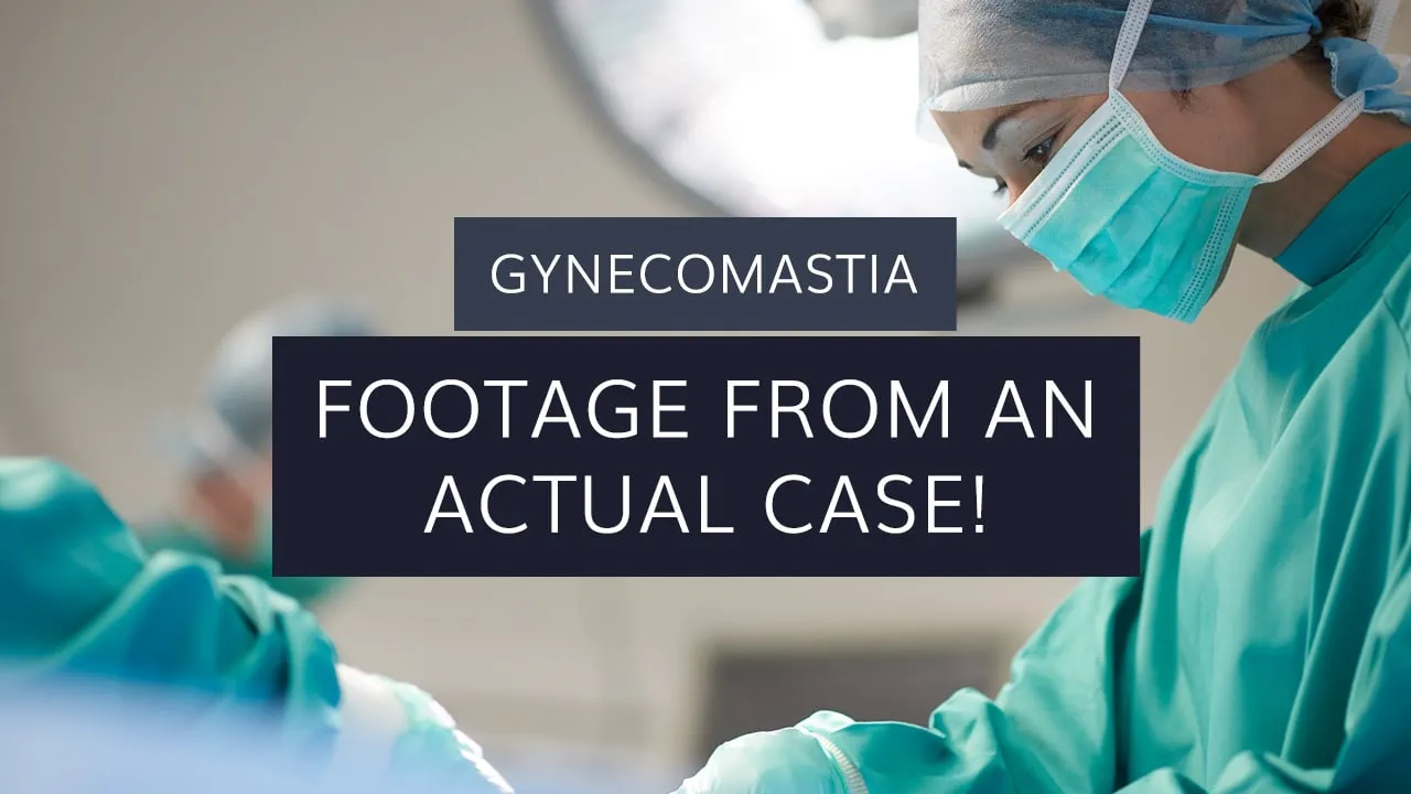 Gynecomastia: Footage From An Actual Case!