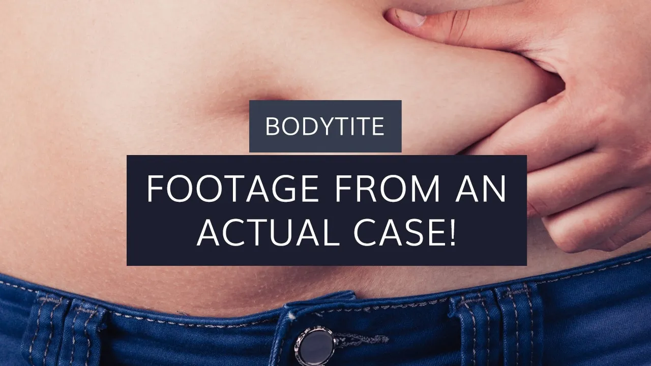 BodyTite: Footage From An Actual Case!