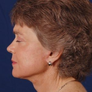 Facelift & Neck Lift — after