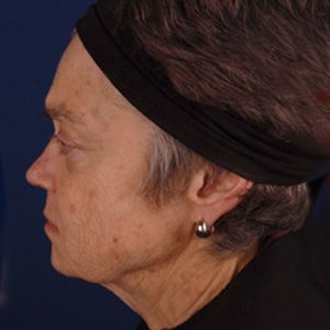 Facelift & Neck Lift — before