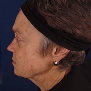 Facelift & Neck Lift — before