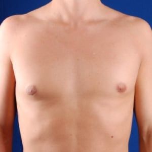 After — Gynecomastia before and after — male chest contour