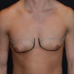 Before — Gynecomastia before and after — male chest contour