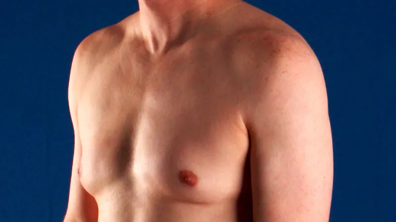 gynecomastia before