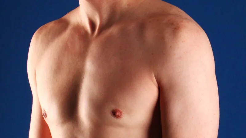 gynecomastia after
