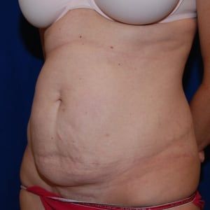 Before — Tummy tuck before and after — loose skin removal
