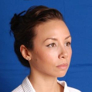 After — Rhinoplasty before and after — tip refinement