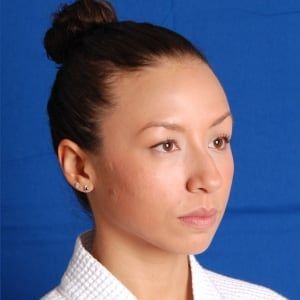 Before — Rhinoplasty before and after — tip refinement