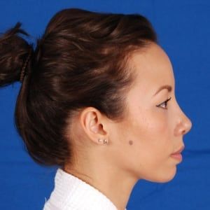 After — Rhinoplasty before and after — profile balance