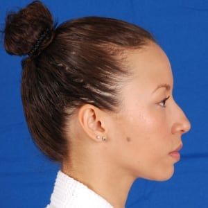 Before — Rhinoplasty before and after — profile balance
