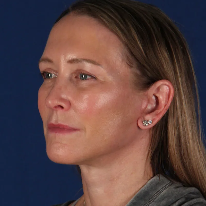 A natural facelift and neck lift result